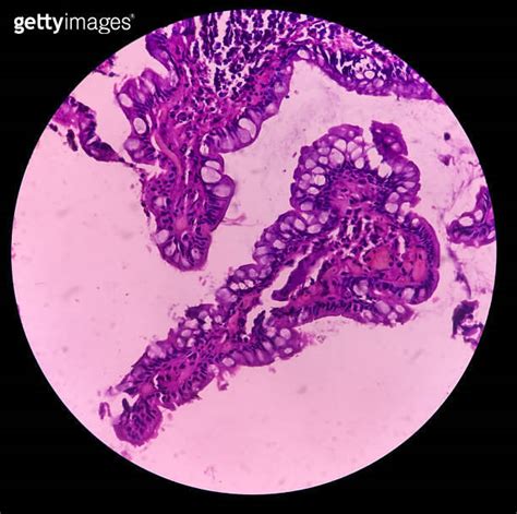 Tissue from terminal ileum: Intestinal ulcer, Chronic nonspecific ileitis with ulcer. 이미지 ...