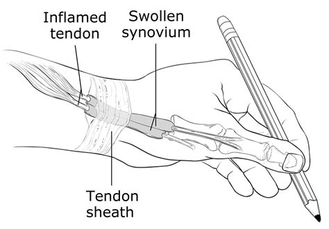 De Quervain’s Tenosynovitis - Causes, Symptoms, Test, Exercise, Surgery