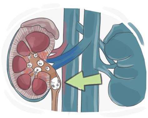 Definition & Meaning of "Renal calculus" | LanGeek