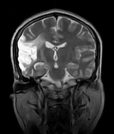 Wallerian degeneration | Radiology Case | Radiopaedia.org