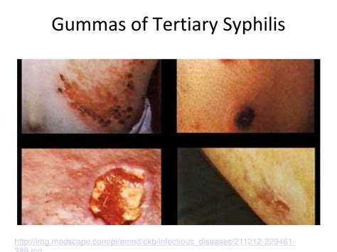 PPT - Syphilis PowerPoint Presentation, free download - ID:3085470