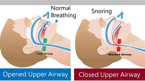 How to stop snoring at night – Ecooe Life