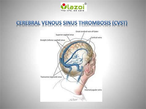 PPT - Cerebral Venous Sinus Thrombosis (CVST) PowerPoint Presentation, free download - ID:7633648