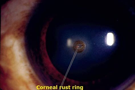 Ophthalmology Notes: SPOTS & DOTS in Ophthalmology