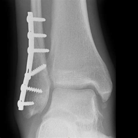 Calcaneal fracture - wikidoc