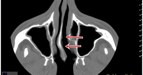 How Can You Understand That "Nasal Septum Deviation" Is In Your Nose?