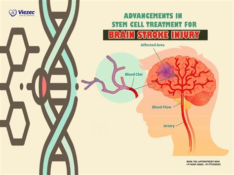 Advancements in Stem Cell Treatment for Brain Stroke Injury