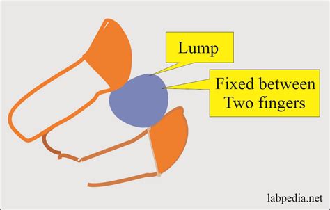 Fine Needle Aspiration Cytology (FNAC)