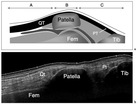 Normal Knee Ultrasound