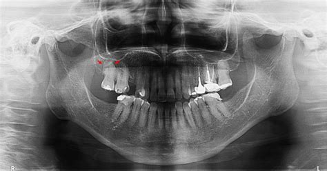 Hipercementosis – Dento Metric | Radiología Dental, Oral y Maxilofacial