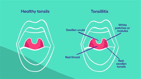 Tonsillitis: Symptoms, causes, and treatments