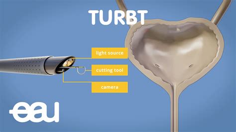 TURBT video - Patient Information