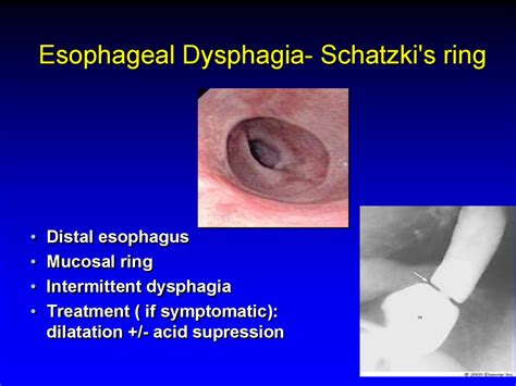 Esophagus. Esophageal Structure - презентация онлайн