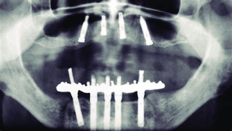 Radiographic appearance after implant installation. | Download ...