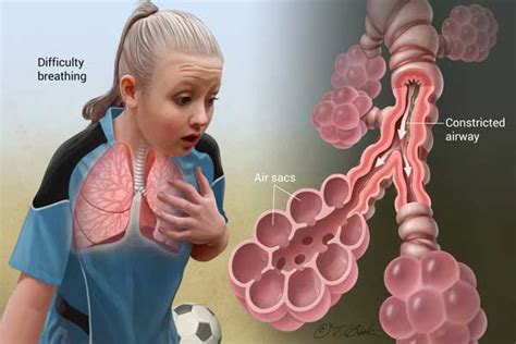 Asthma symptoms