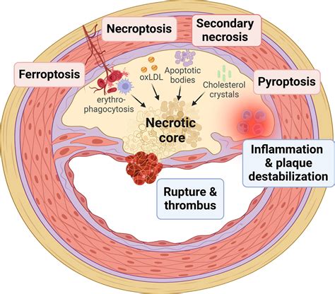 Regulated Necrosis in Atherosclerosis | Arteriosclerosis, Thrombosis, and Vascular Biology