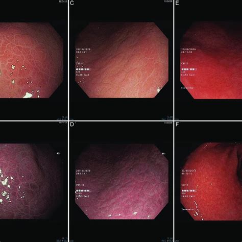 Endoscopic images of patients infected by Helicobacter pylori. (A)... | Download Scientific Diagram