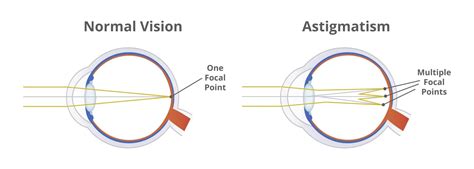 Vivity™ Lens: Cataract & Astigmatism Correction