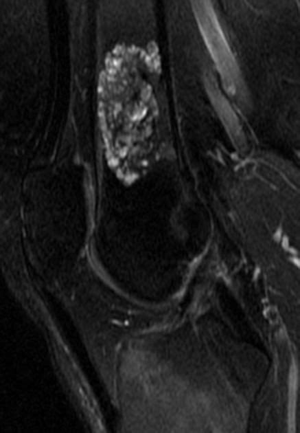 Enchondroma MRI - T1: intermediate to low-signal with focal regions of signal drop out where ...