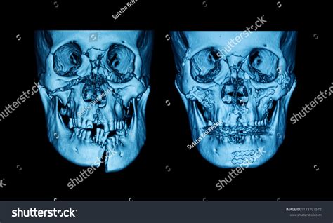 Ct Scan Facial Bone Fractures Front Foto stock 1173197572 | Shutterstock