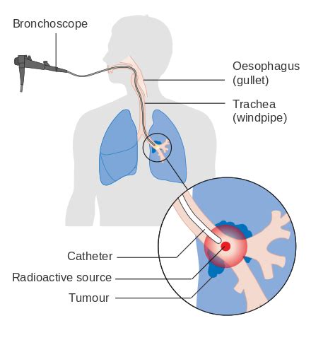 Lung cancer - Wikipedia