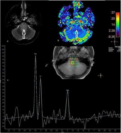 a–c On MRI perfusion (a and b), no increase in perfusion is observed in ...