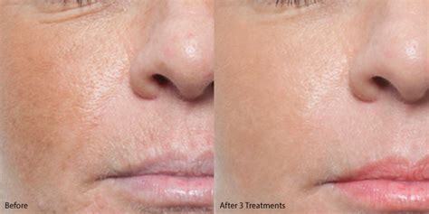 Microneedling Before and After Gallery - MD Needle PenMD Needle Pen