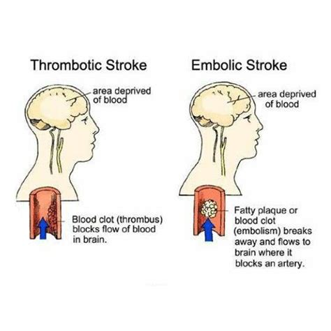 Stroke Risk Factors