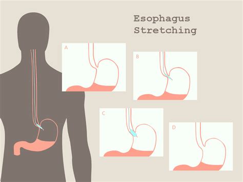 Esophagus Stretching - Uses and Risks of Esophageal Dilation - Drug Genius