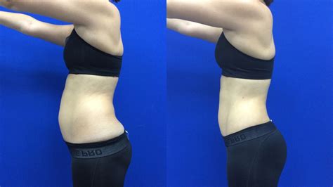 I Tried Laser Liposuction — Before and After Laser Liposuction Photos | Allure