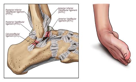 KECEDERAAN DALAM SUKAN (ANKLE) – Institut Sukan Negara