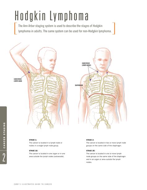 Hodgkin Lymphoma the Ann Arbor Staging System Is Used to Describe the Stages of Hodgkin ...