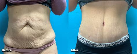 Best Tummy Tuck Oklahoma City | Bajaj Plastic Surgery