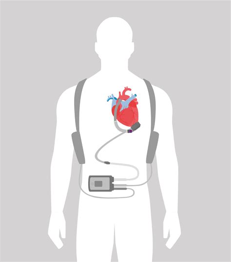 Helping hearts beat in innovative trial - Department of Surgery