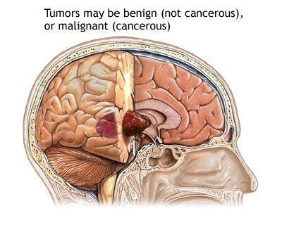 Brain Tumor Symptoms