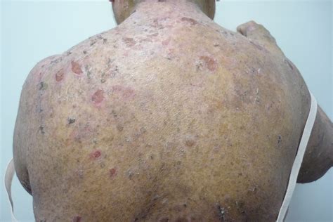 Pemphigus, Vulgaris, Foliaceus, Paraneoplastic Pemphigus Treatment