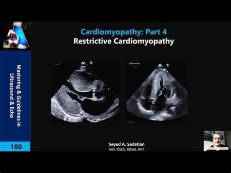 Restrictive Cardiomyopathy - YouTube