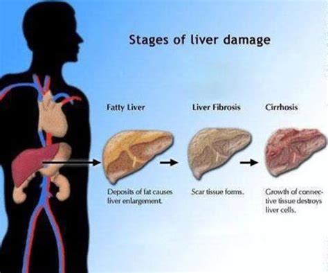 What are the 4 Stages and Symptoms of Cirrhosis - I Help C