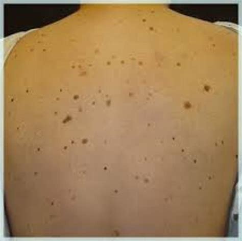 17 Simple Ways To Get Rid Of Moles On Any Part Of The Body | HubPages