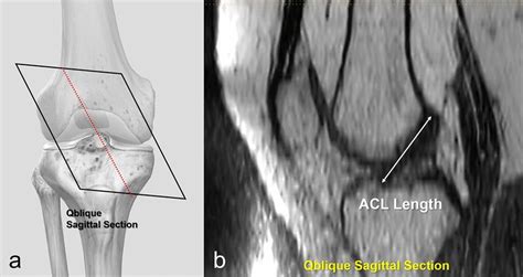 a The course of ACL on the oblique sagittal plane. b The measurement of ...