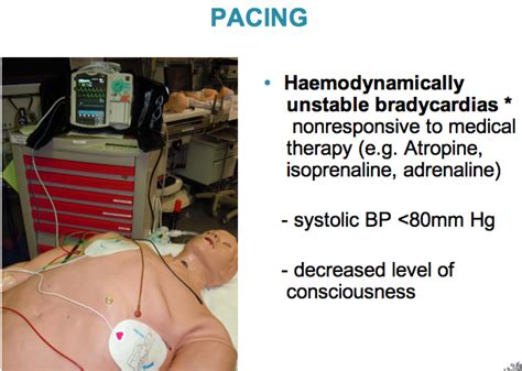 Transcutaneous pacing. Emergency external pacing. | Advanced Life Support / ALS | Pinterest