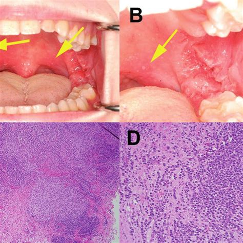 (A,B) Areas of mildly erythematous mucosa and multiple aphthous ulcers... | Download Scientific ...