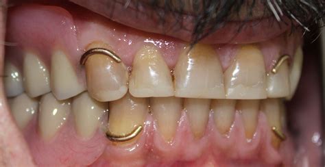 1-what-does-a-upper-and-lower-metal-dentures-with-gold-clips-look-like