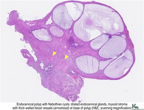 Pathology Outlines - Endocervical polyp