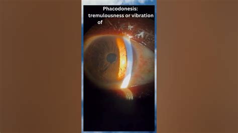 Phacodonesis & Iridodonesis #eyecare #eyedoctor #neetpg #eyehealth #ophthalmology #visions # ...