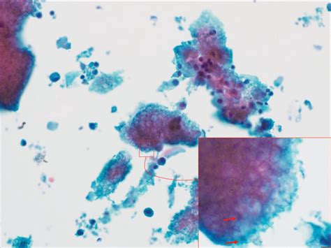 The cytological diagnosis of Pneumocystis jiroveci pneumonia in ...