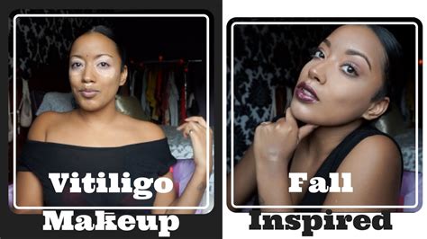 Vitiligo Makeup For Dark Skin | Saubhaya Makeup