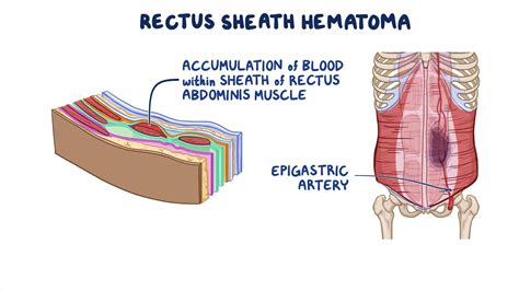 Rectus sheath hematoma: Clinical sciences - Osmosis Video Library