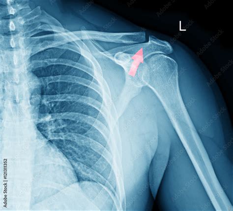 X-ray film of shoulder fracture Stock Photo | Adobe Stock