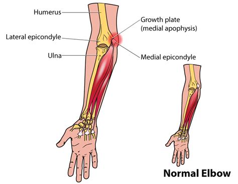 Little Leaguer's Elbow | Symptoms, treatment, surgery & pitch counts